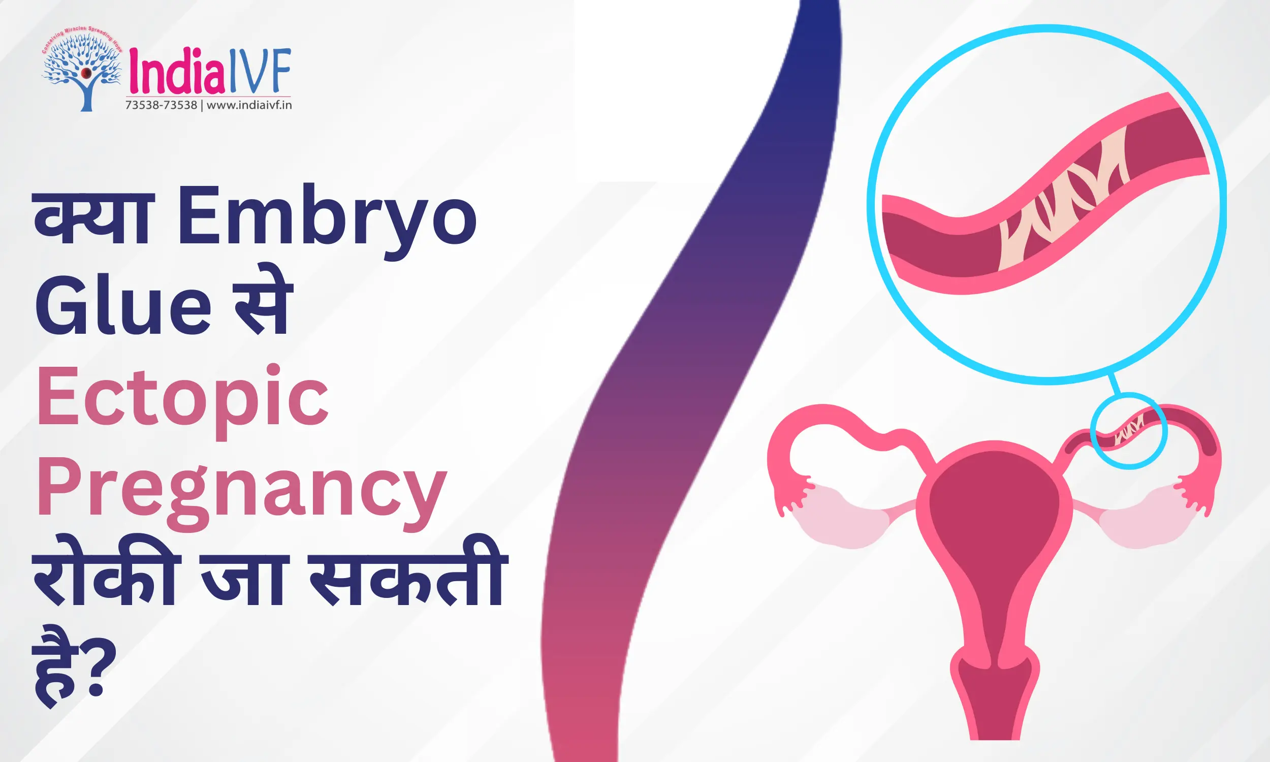 क्या Embryo Glue से Ectopic Pregnancy रोकी जा सकती है?