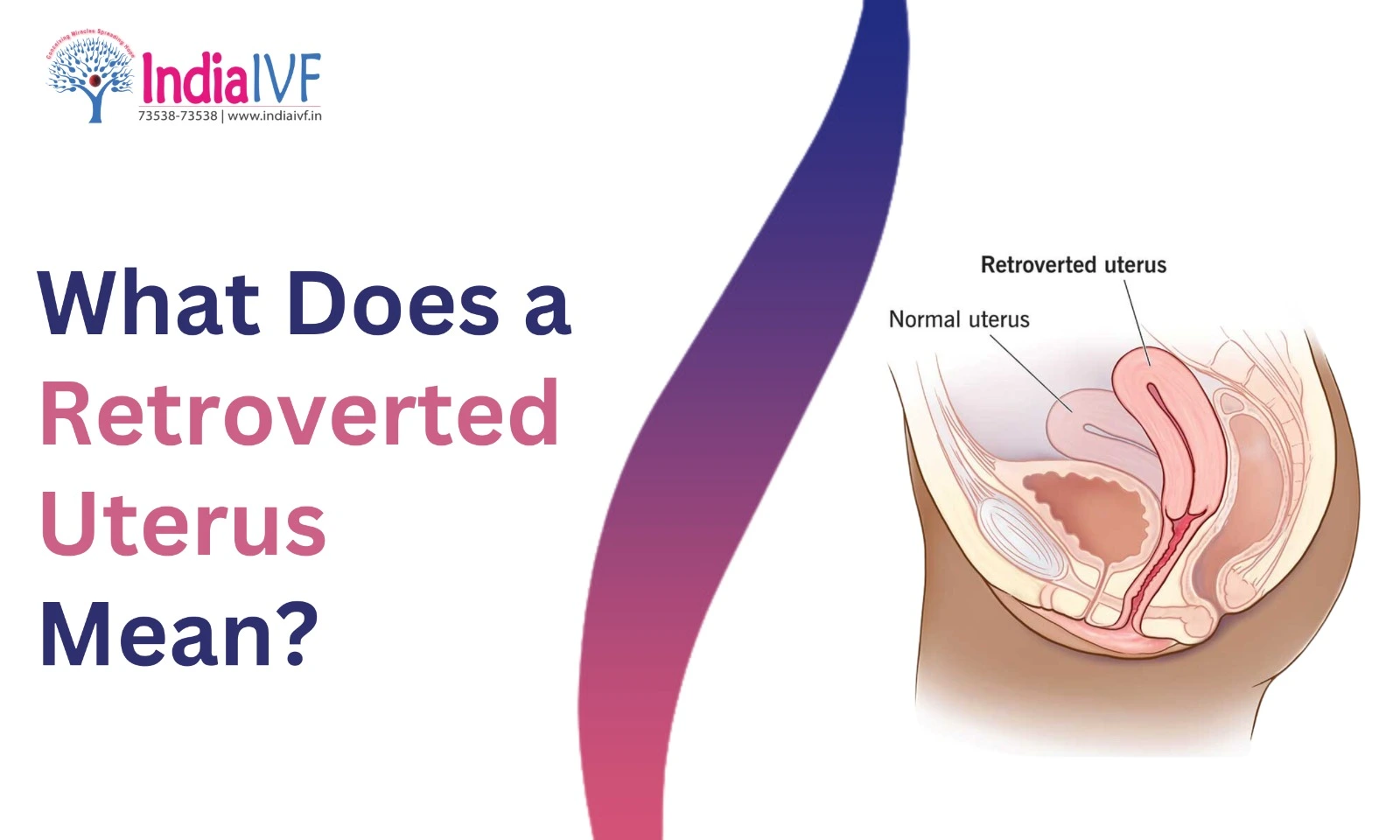 Retroverted Uterus Mean