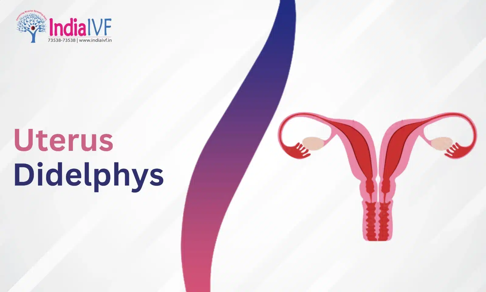 Uterus Didelphys