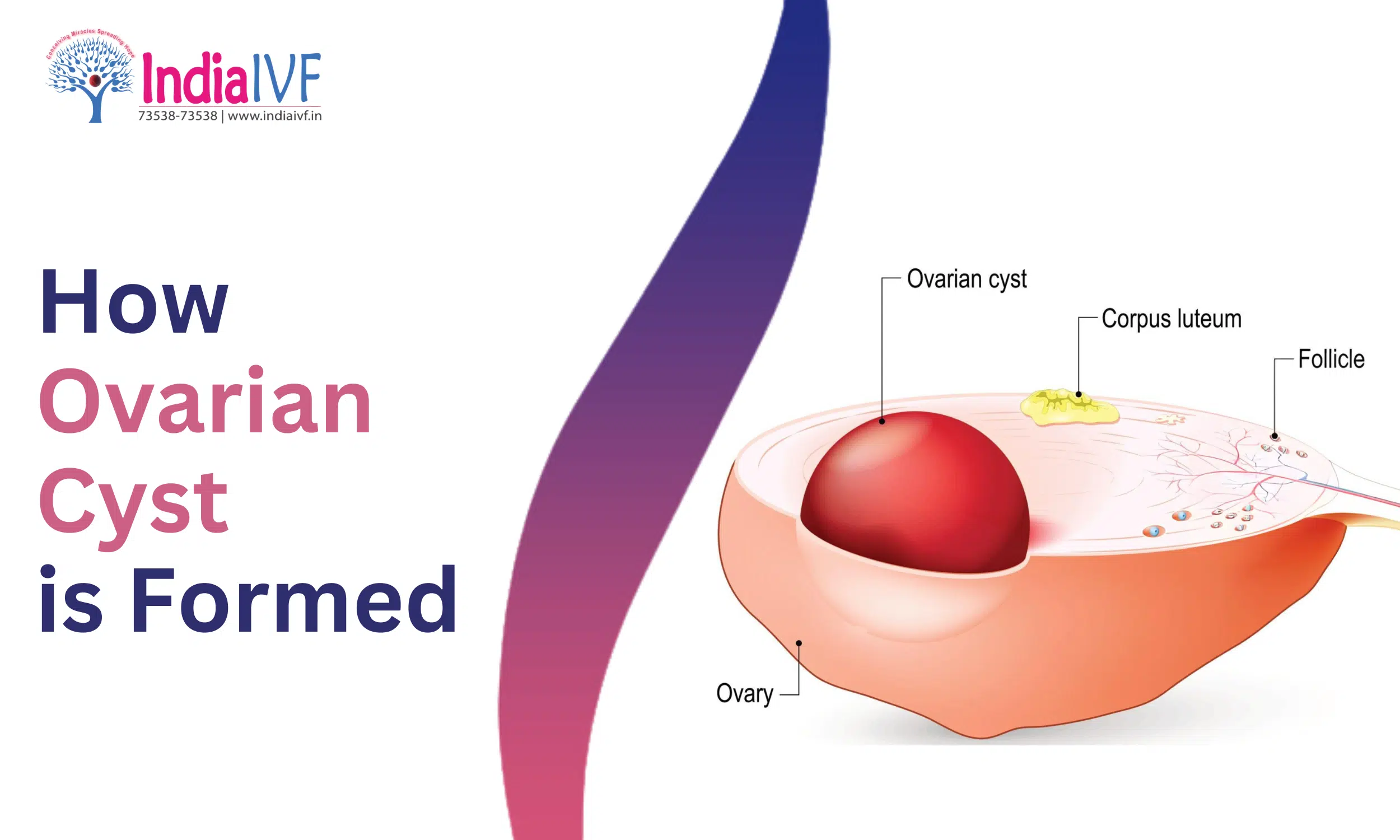 How Ovarian Cyst is Formed